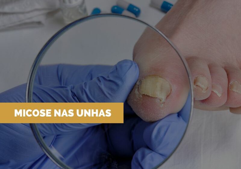 Tratamento-Micose Tratamento para unhas com Micose