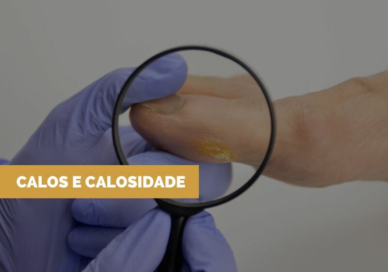 Tratamento-para-calos Tratamento para Calos