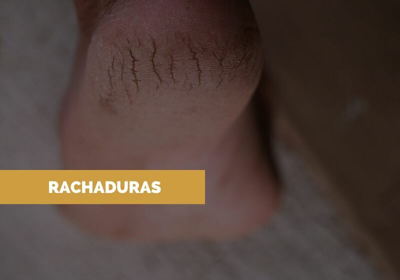 Tratamento-rachaduras Tratamento para Rachaduras nos Pés
