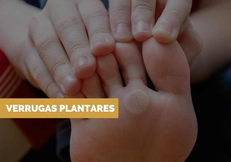 Tratamento-verruga Tratamento para Verruga