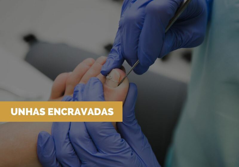 Unhas-Encravadas Tratamento para Unhas Encravadas Especializada em Homens